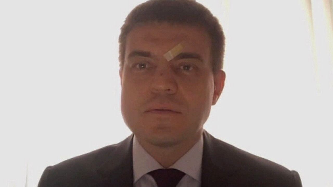У главы Красноярского края заметили кровоподтеки на лице