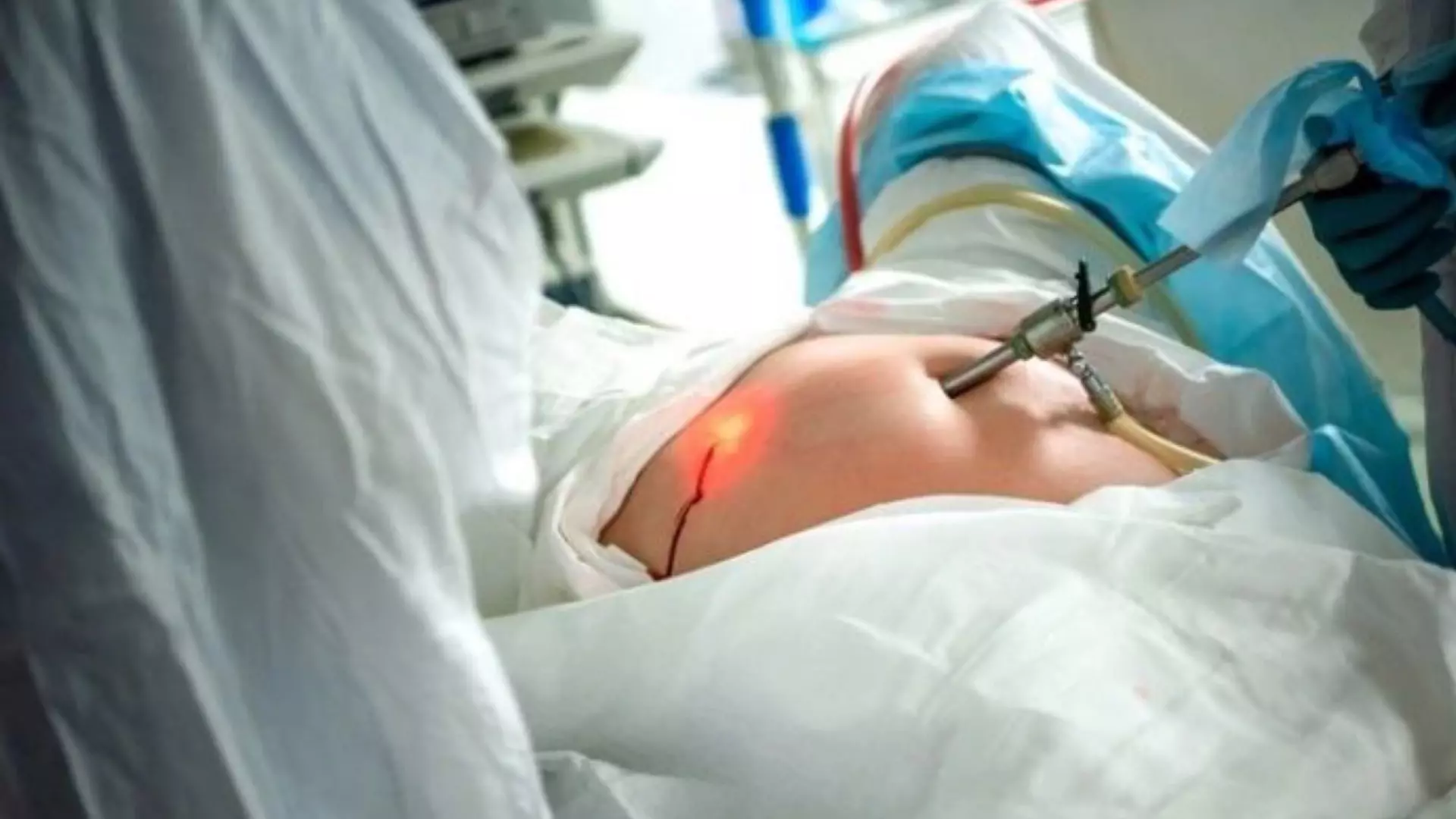 В праздники красноярские врачи спасли беременную с разрывом мочевого пузыря